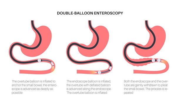 Enteroscopia de doble balón procedimiento mínimamente invasivo visualización del intestino delgado biopsia eliminación de pólipos terapia de sangrado colocación de stent en el tracto gastrointestinal ilustración vectorial