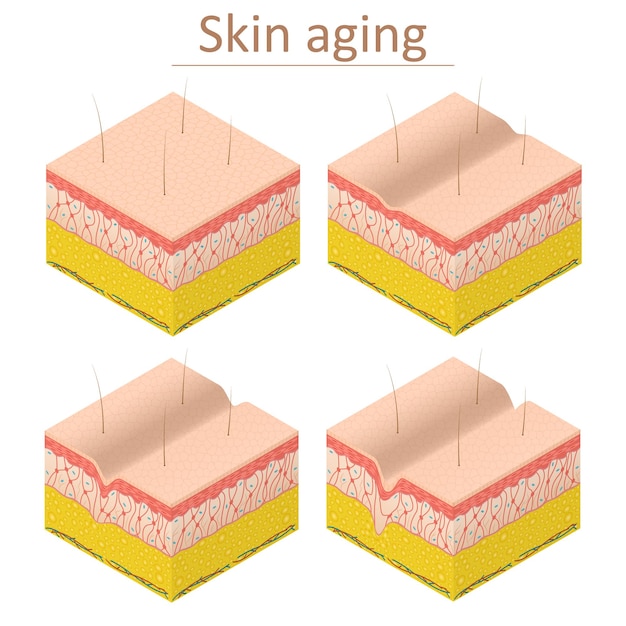 Envejecimiento de la piel, vista isométrica, epidermis normal y arrugada para póster y tarjeta. Ilustración vectorial