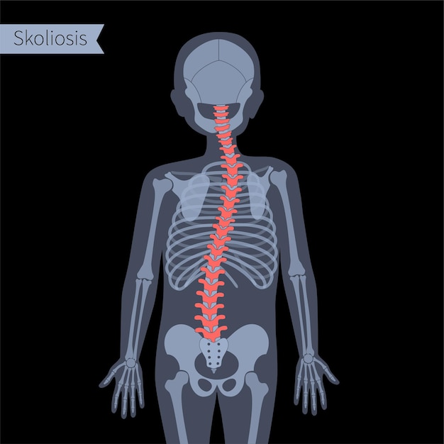 Escoliosis combinada en el cuerpo del niño. Ilustración de vector plano de rayos X Anatomía de la columna vertebral, la columna vertebral, las articulaciones y el esqueleto en la silueta del niño. Cartel ortopédico. Bandera médica. Examen en el centro de dolor espinal, clínica.
