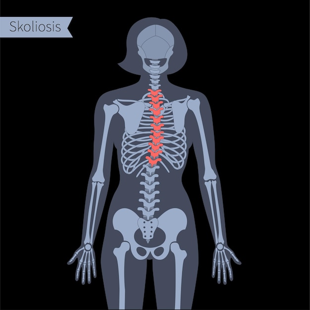 Escoliosis torácica en el cuerpo femenino. ilustración de vector plano de rayos x. anatomía de la columna vertebral, la columna vertebral, las articulaciones y el esqueleto en silueta de mujer. cartel ortopédico. bandera médica. examen en el centro de dolor espinal, clínica