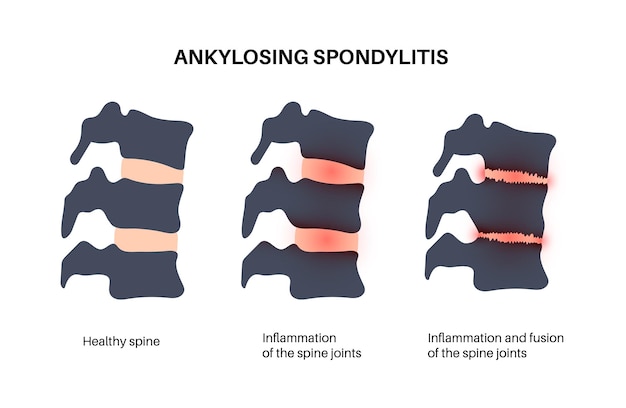 Espondilitis anquilosante Artritis que causa inflamación en las articulaciones y ligamentos de la columna vertebral Vértebras inflamadas y fusionadas en la columna vertebral Ilustración de vector de dolor de cadera y espalda baja