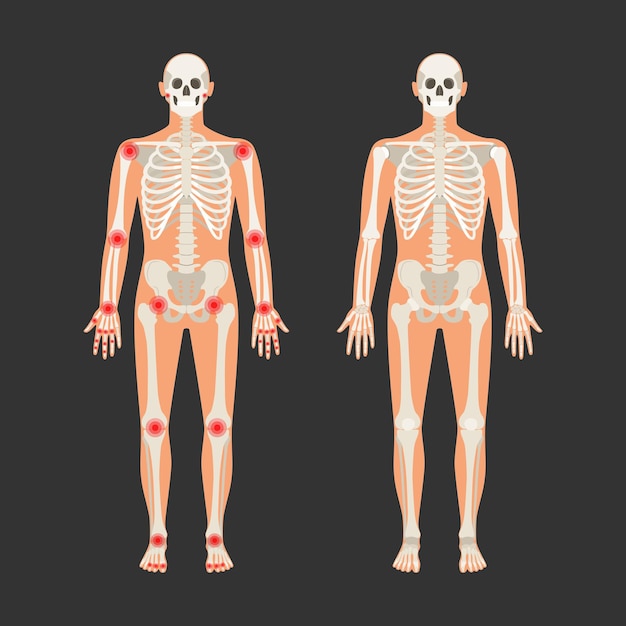 Esqueleto humano con puntos de dolor en la artritis reumatoide Ilustración de anatomía masculina con una silueta corporal Vector aislado plano de cráneo y huesos en el cuerpo