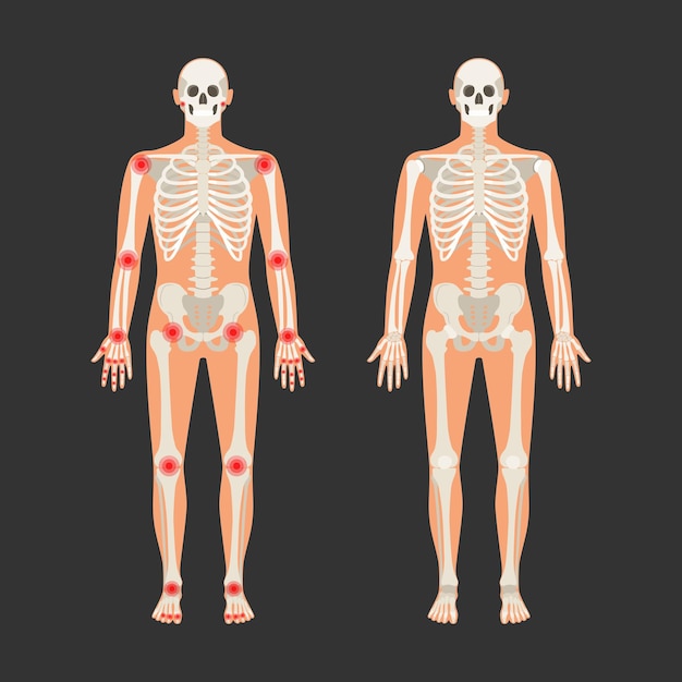 Vector esqueleto humano con puntos de dolor en la artritis reumatoide ilustración de anatomía masculina con una silueta corporal vector aislado plano de cráneo y huesos en el cuerpo