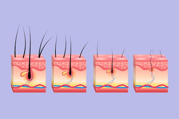 Esquema gradiente de pérdida de cabello