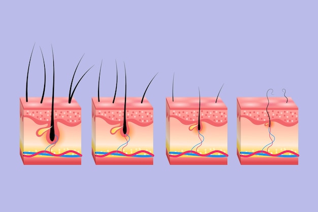 Vector esquema gradiente de pérdida de cabello