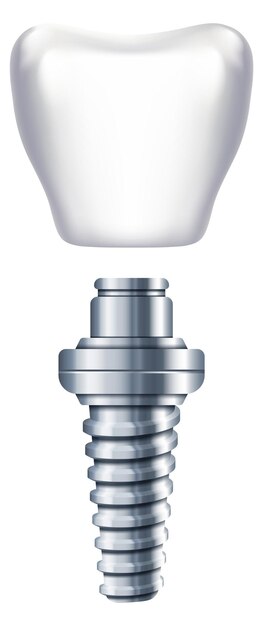Esquema de implantes dentales Sustitución de dientes Ilustración de ortodoncia