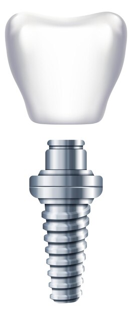 Vector esquema de implantes dentales sustitución de dientes ilustración de ortodoncia