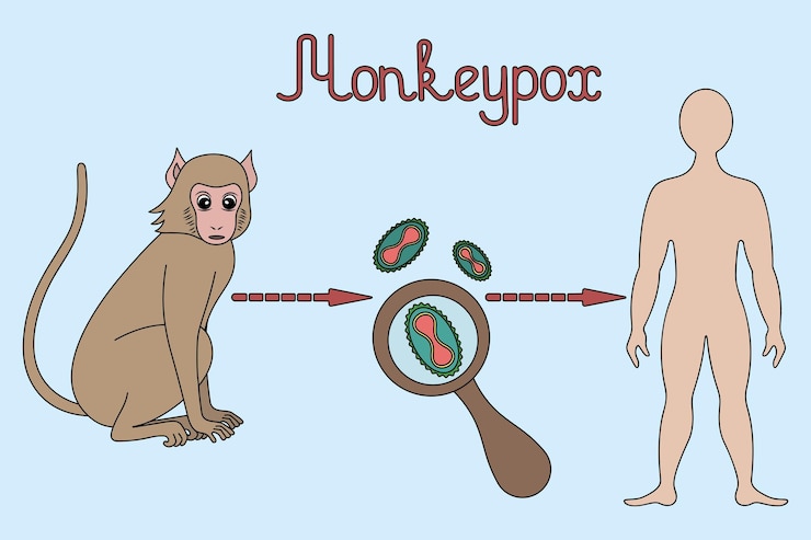 Vector esquema de infección humana del virus de la viruela del mono con el virus de la viruela del mono en estilo de dibujos animados
