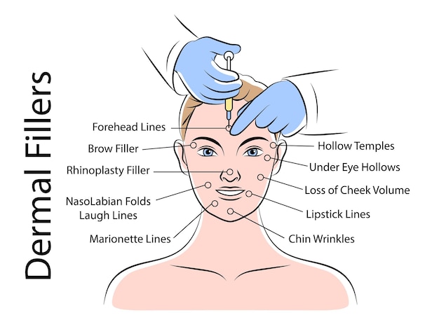 Esquema de infografías de inyecciones de belleza