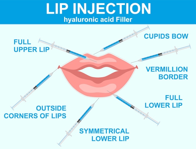 Esquema de inyecciones de ácido hialurónico en los labios Zonas anatómicas detalladas