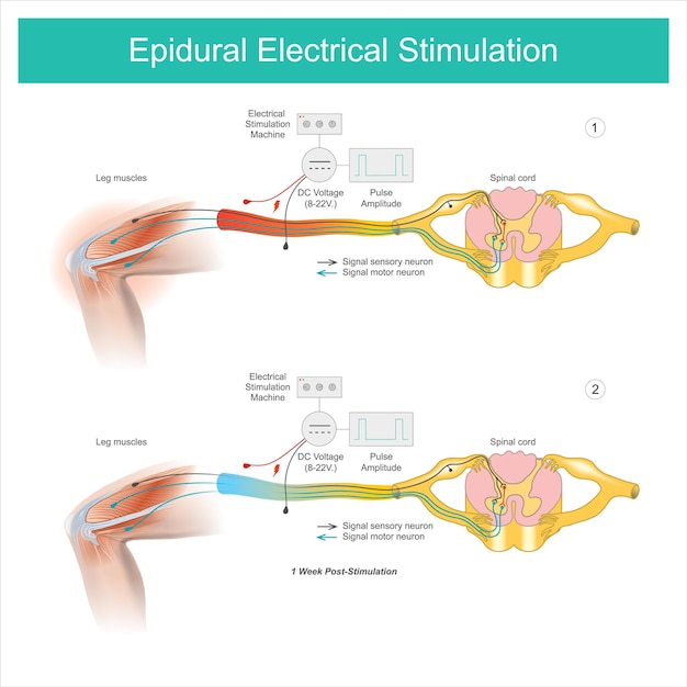 Estimulación eléctrica epidural Síntoma de dolor muscular en el área de la pierna y tratamiento mediante estimulación eléctrica en la piel y luego pasa a los músculos y nervios de la piernaxA