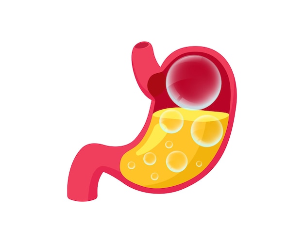 Estómago hinchado con gases bolas transparentes dentro del sistema digestivo problema de hinchazón comer en exceso