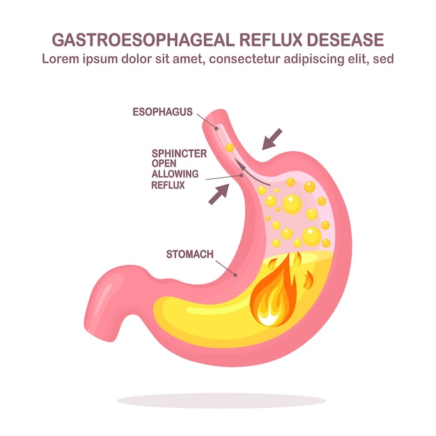 Estómago humano. Enfermedad por reflujo gastroesofágico. ERGE, acidez estomacal, infografía gástrica. El ácido sube al esófago.