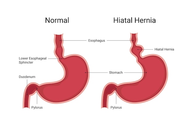 Estómago humano normal en comparación con la hernia hiatal