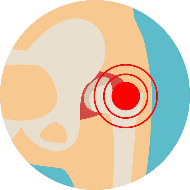 Estructura de la articulación de la cadera Artritis de la articulación de la Cadera Osteoartritis del icono Dolor fractura o inflamación