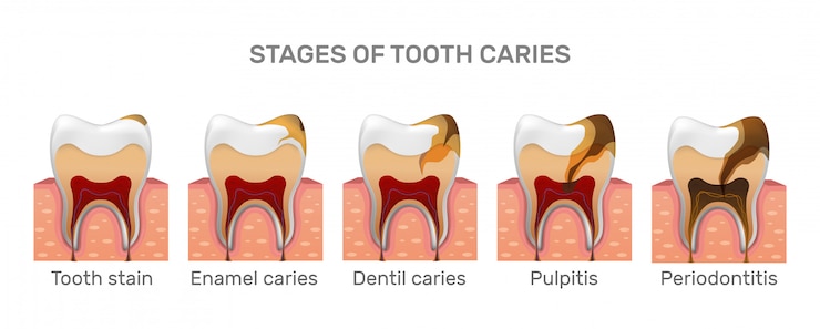 Vector estructura de caries dental y pasos completos de colocación en estilo realista.