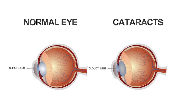 Vector la estructura de la catarata del ojo.