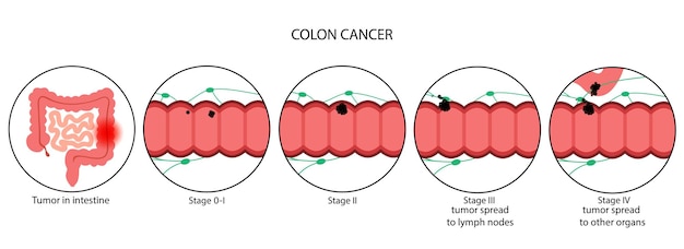 Etapa del cáncer de colon