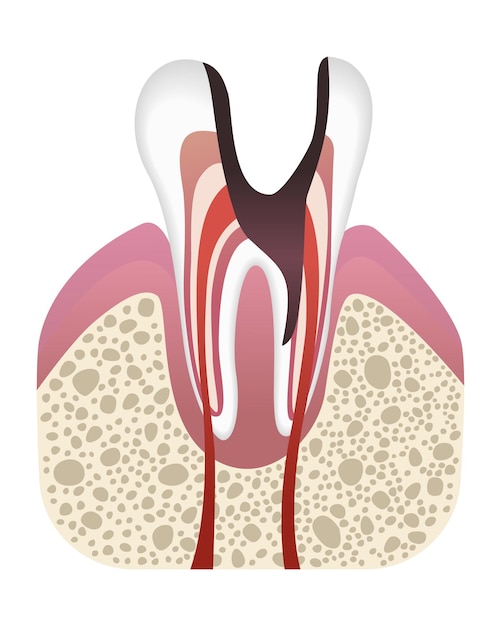 Etapa de desarrollo de caries Estructura dental en estilo plano Caries dental con esmalte Enfermedad dental ilustración vectorial realista