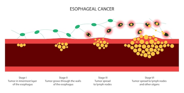 Vector etapas del cáncer de esófago