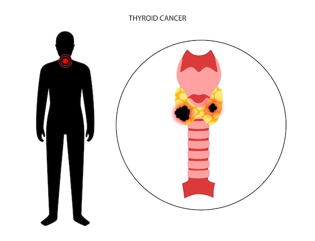 Etapas del cáncer de tiroides