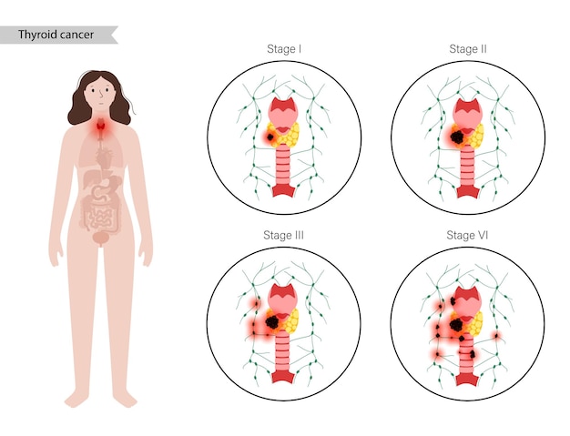 Etapas del cáncer de tiroides