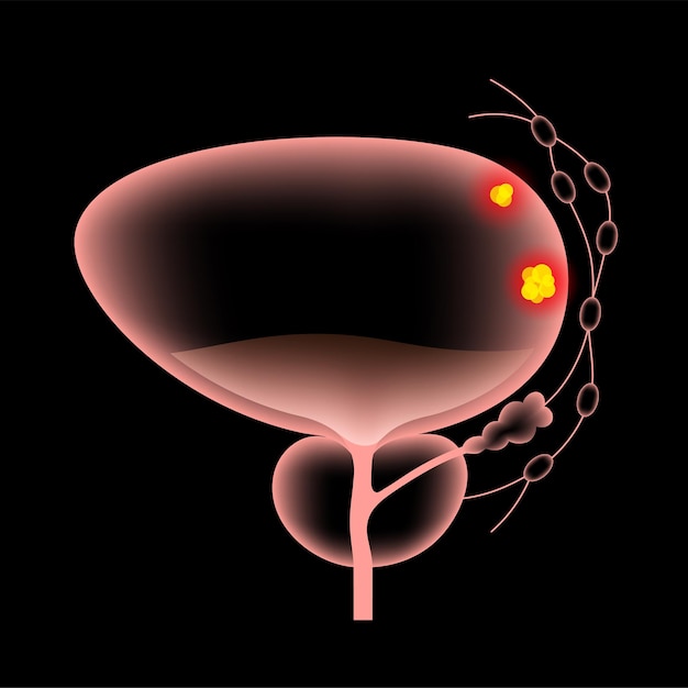 Etapas del cáncer de vejiga. Cartel anatómico realista 3d.