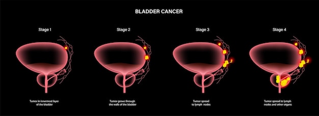 Etapas del cáncer de vejiga