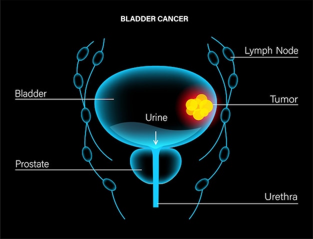 Etapas del cáncer de vejiga