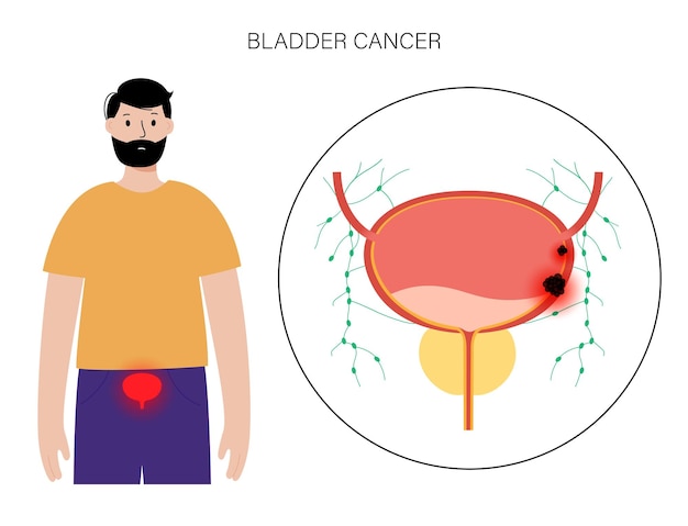 Etapas del cáncer de vejiga