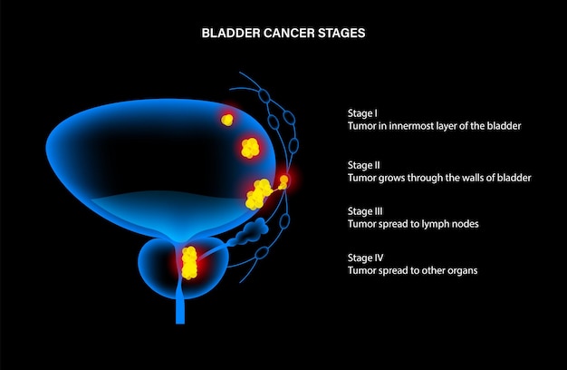 Vector etapas del cáncer de vejiga