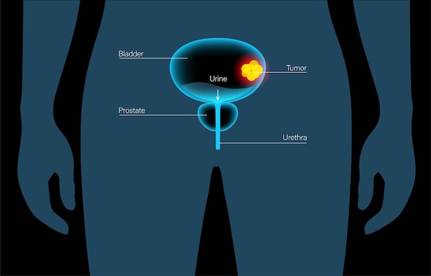 Vector etapas del cáncer de vejiga