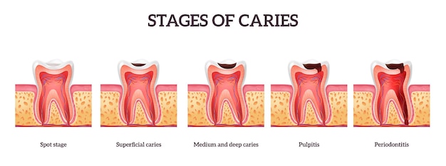 Etapas de la caries