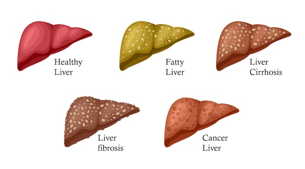 Vector etapas del daño hepático enfermedad hepática