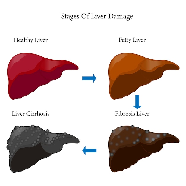 Vector etapas del daño hepático fibrosis y cirrosis hepáticas grasas sanas aisladas en fondo blanco