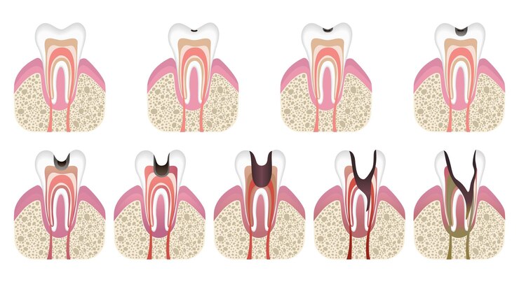 Vector etapas del desarrollo de caries estructura dental en estilo plano caries dental con esmalte enfermedad dental caries pulpitis y periodontitis ilustración vectorial realista