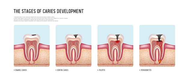 Etapas del desarrollo de la caries Ilustración vectorial