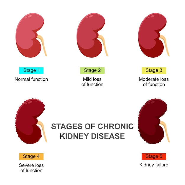 Vector etapas de la enfermedad renal crónica problema de ilustración vectorial del concepto infográfico en el sistema urinario