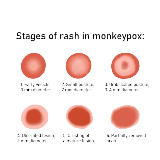 Etapas de la erupción en la viruela del mono monkeypox virus enfermedad viral zoonótica que puede infectar a humanos no humanos