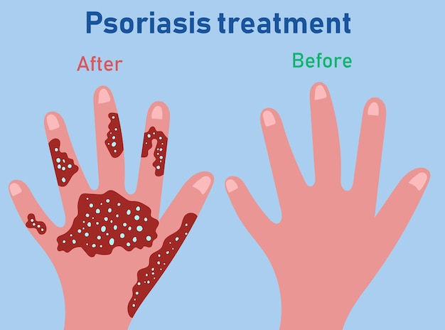 Etapas de formación de la psoriasis