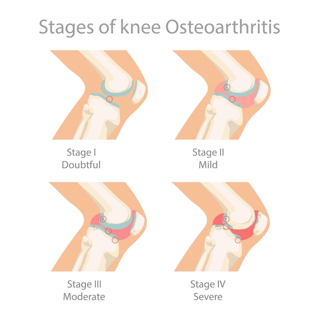 Etapas de la osteoartritis de rodilla.