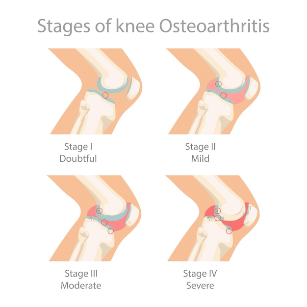 Etapas de la osteoartritis de rodilla.