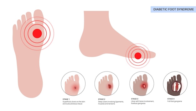 Etapas del síndrome del pie diabético Úlcera profunda, llaga abierta o herida en los pies Inflamación de los ligamentos, tendones y huesos Infección por gangrena y amputación Dolor en la pierna Vector de diagnóstico y tratamiento