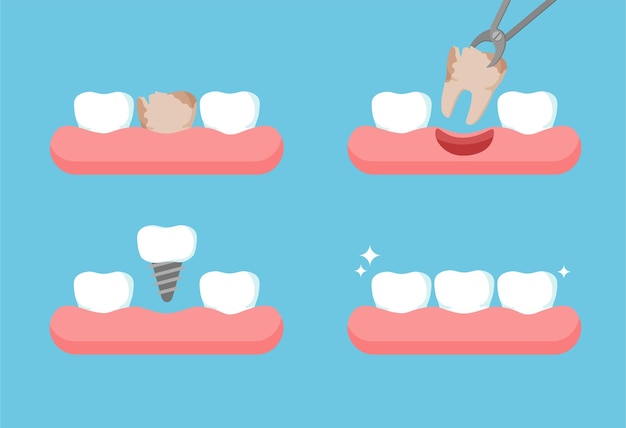 Etapas del tratamiento dental el diente se extrae con fórceps fila de dientes con implante dental