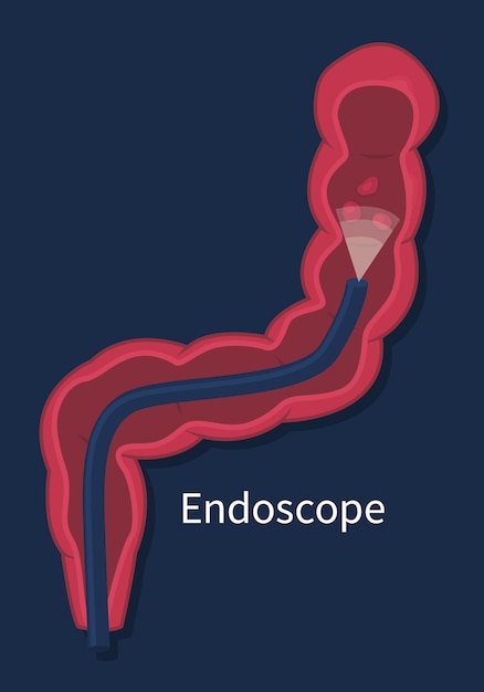 Examen de detección de cáncer colorrectal, procedimiento de extirpación de pólipos