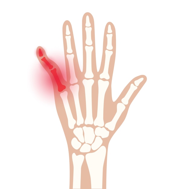 Vector exploración de rayos x con dedo brocen. fractura de dolor e inflamación en la mano. problema con la articulación