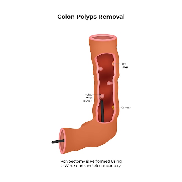 La extirpación de pólipos del colon pólipos planos pólipos de cáncer pólipos con una polipectomía del tallo se realiza utilizando
