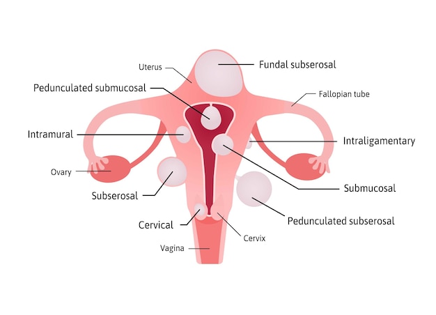 Vector fibromas uterinos crecimientos no cancerosos del útero