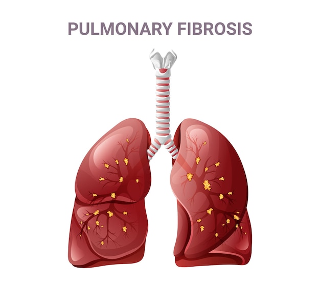 Fibrosis pulmonar y pulmón normal ilustración vectorial aislada sobre un fondo blanco