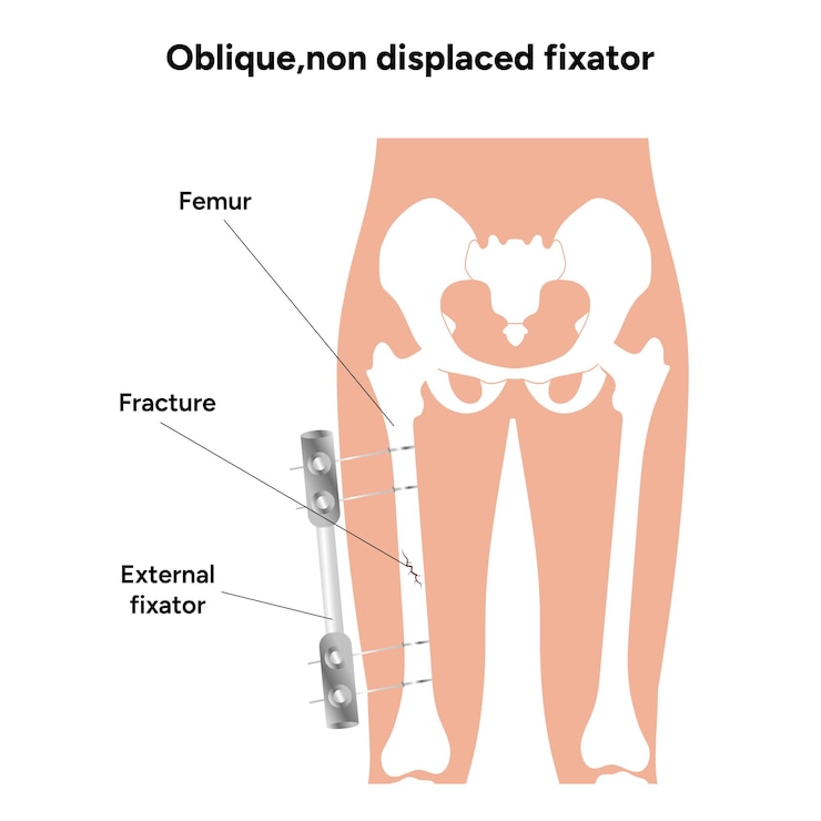 Vector fixador oblicuo no desplazado